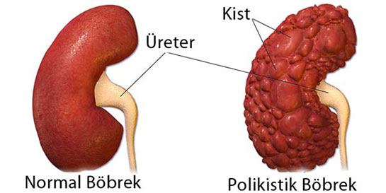 Böbrek Üstü Bezi Kisti Böbrek Üstü Bezi Kisti