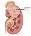 Böbrek Tümörü Belirtileri Nelerdir?