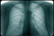 Böbrek Üşütmesi Belirtileri ve Tedavisi