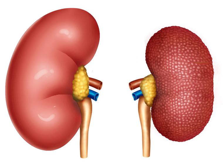 Atrofik Böbrek Alınmalı mı?